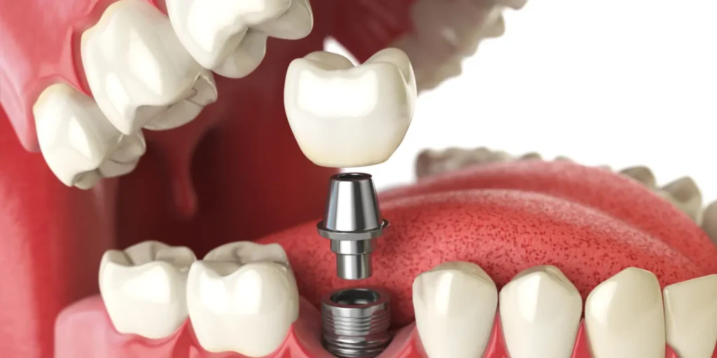 Dental tools that uses in dental implant