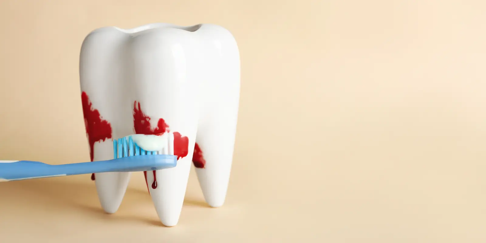 Dental Gum disease structure