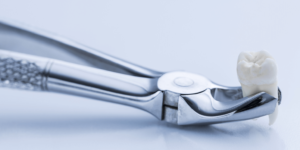 Close-up of dental extraction forceps with a tooth ready for removal